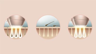 Expert IPL technology at-home, developed with dermatologists