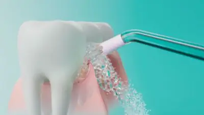 Quadstreami tehnoloogia: eemaldab kattu igemepiirilt